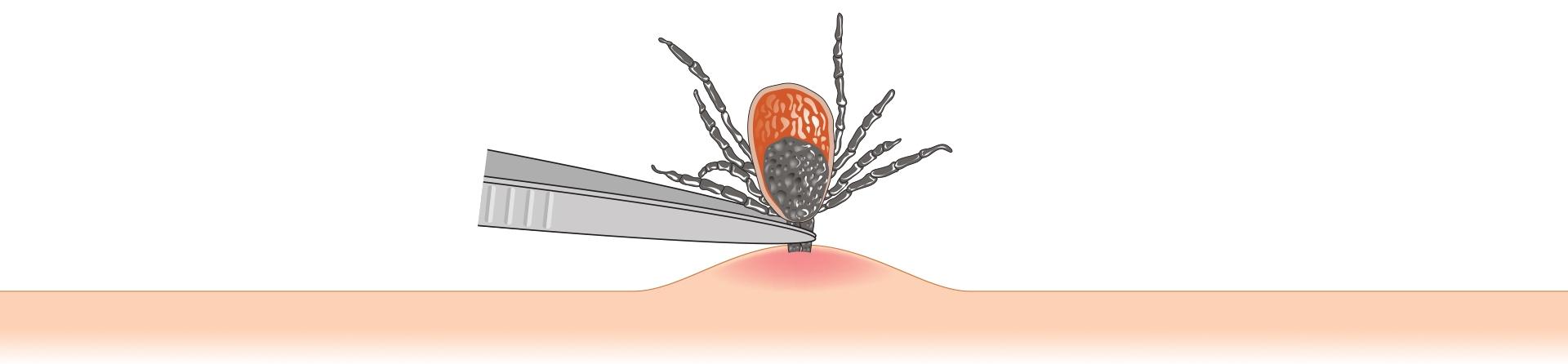How To Remove Tick