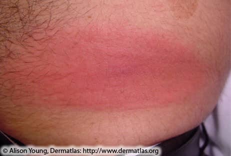 Lyme Disease Rash 5A